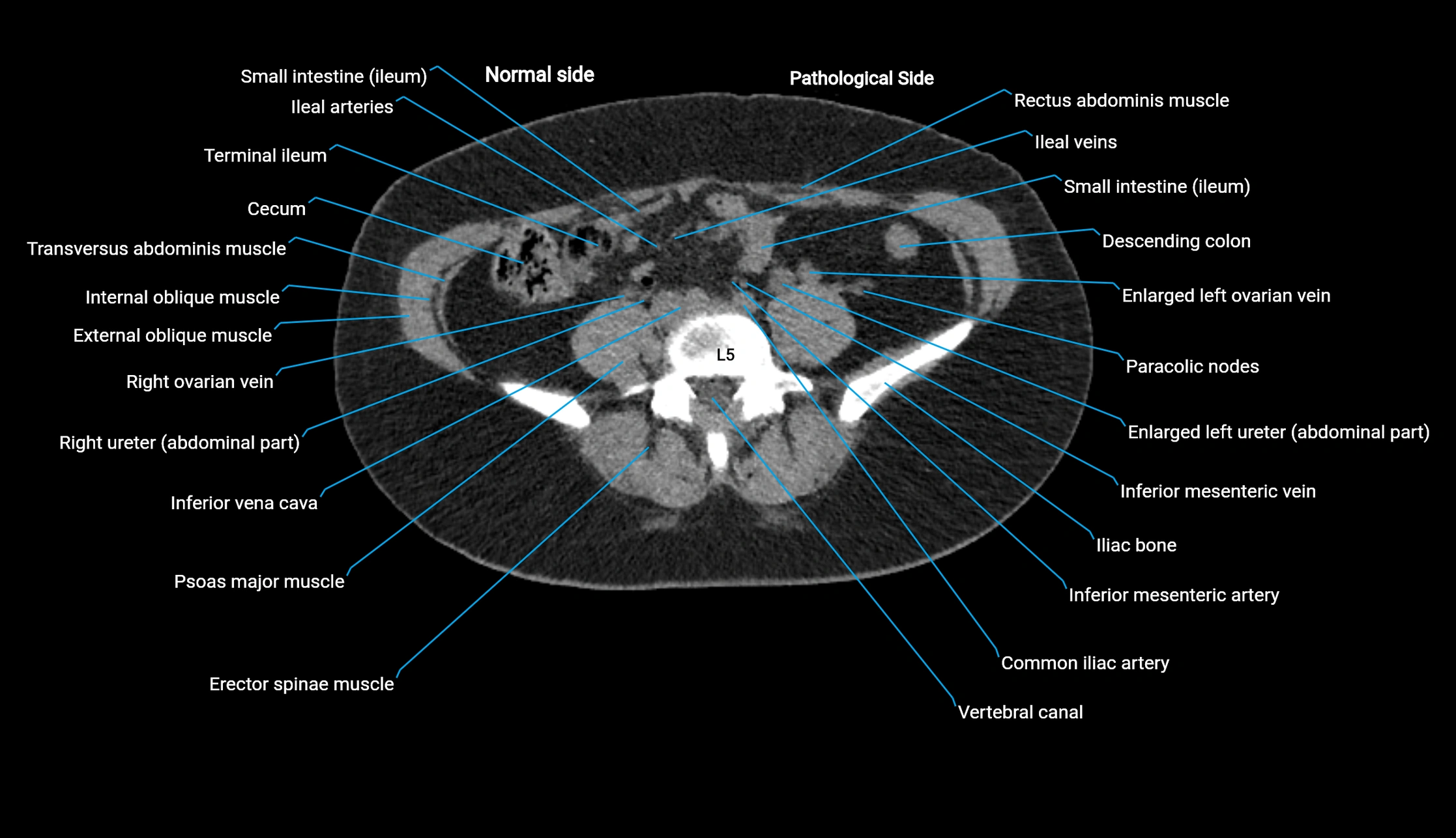 CT KUB axial cross sectional anatomy  radiology image -img-00201-00097.webp